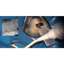 Meta CeraSeal RC Sealer - 4