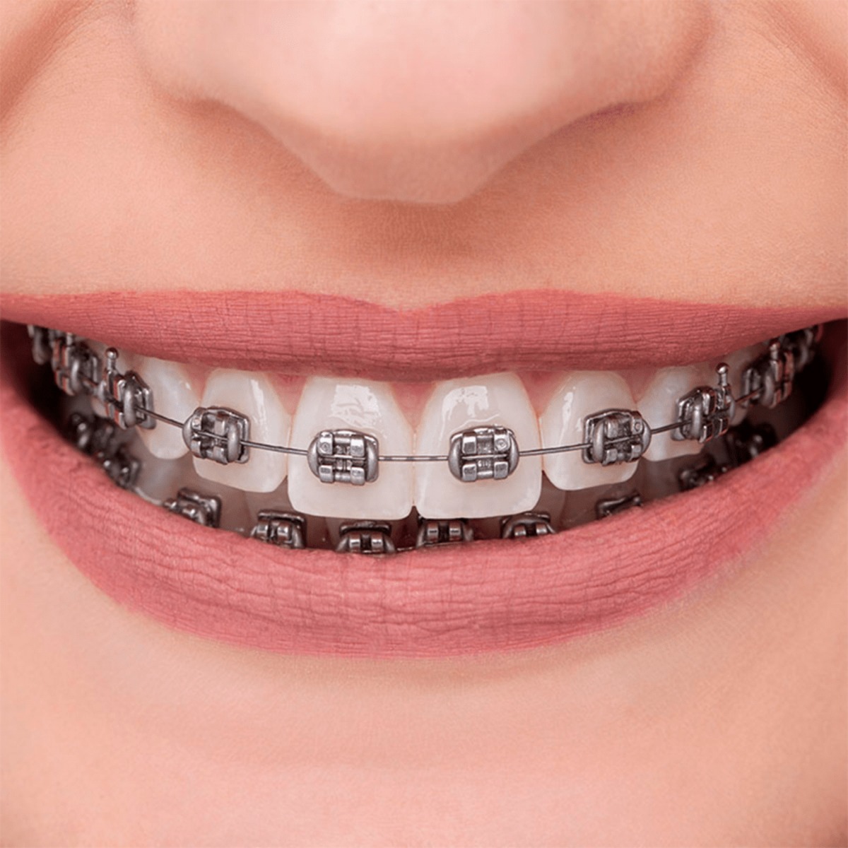 OrthoMetric Advanced Series Metal Bracket Kit