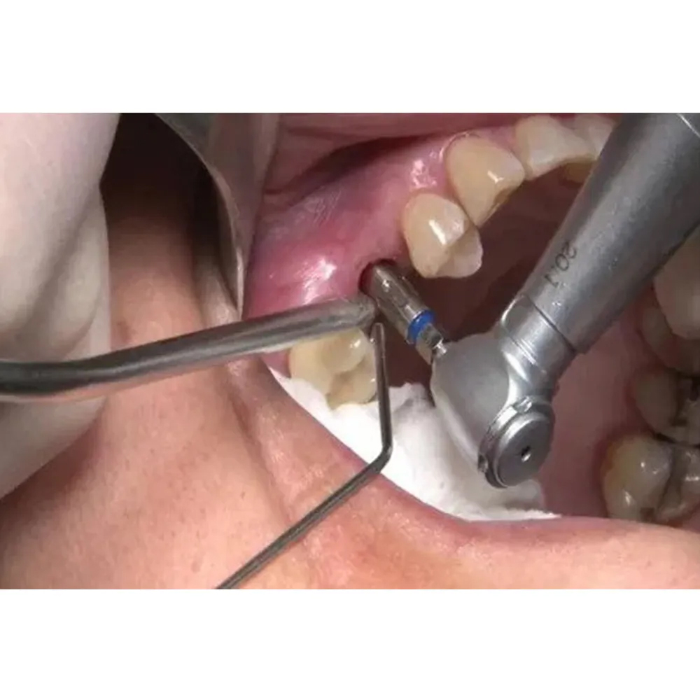 GDC Metal Suction Tip (2.0mm) (Aspct2)