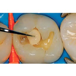 Prime Dental Restorite Micro Hybrid Kit - 4