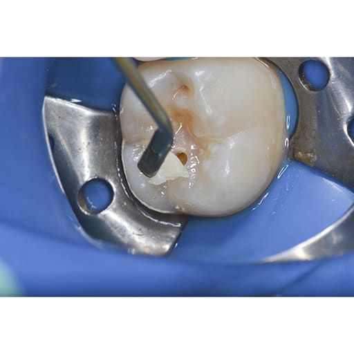 Prime Dental Restorite Micro Hybrid Composite