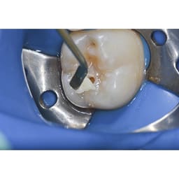 Prime Dental Restorite Micro Hybrid Kit - 3