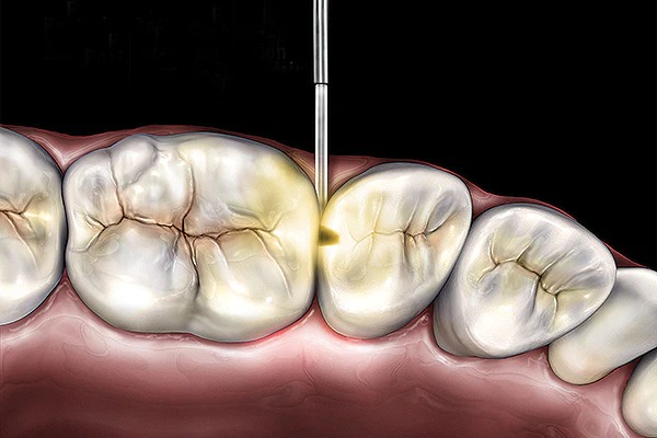AdDent Microlux Transilluminator Diagnostic System With Perio/Endo Probe