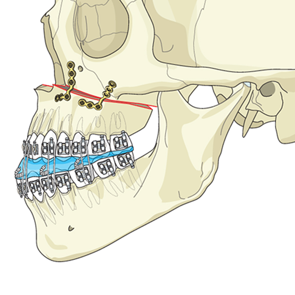 SK Surgicals SS Mini Bone Plates L Shape 90° With Gap - 2mm