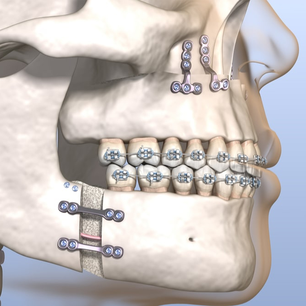 SK Surgicals SS Mini Bone Plates T Shape With Gap - 1.5mm