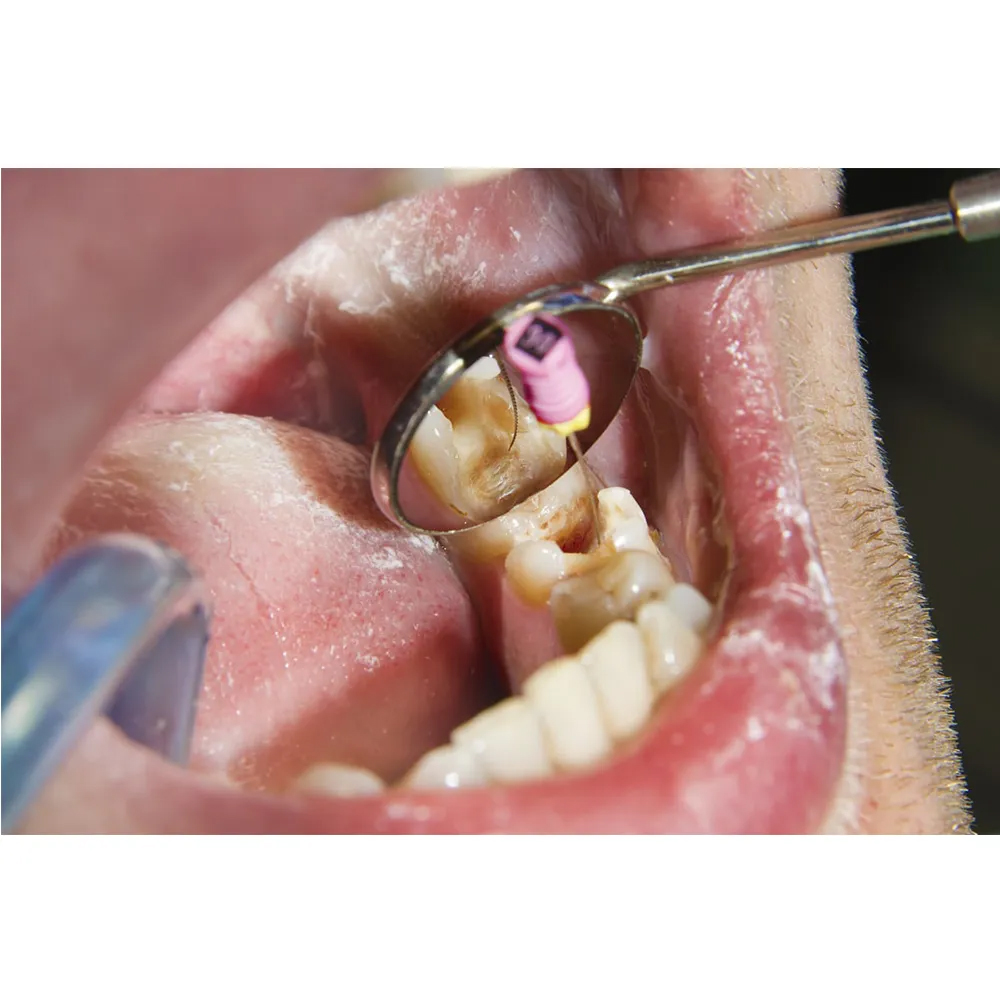 Waldent Mouth Mirror Tops Plain #4 Pack of 12 (K13/4)