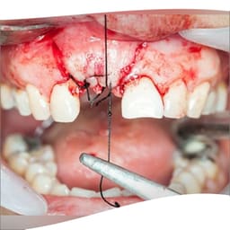Meril Filapron #2-0 Polyglecaprone 25 Suture - 6