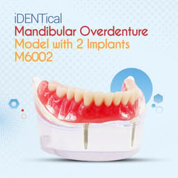 iDENTical Mandibular Overdenture Model with 2 Implants M6002 - 18