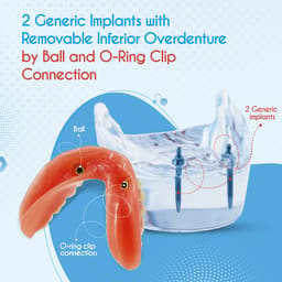 iDENTical Mandibular Overdenture Model with 2 Implants M6002 - 17