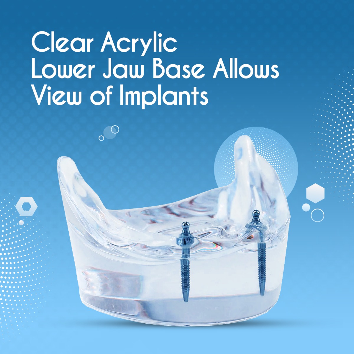 iDENTical Mandibular Overdenture Model with 2 Implants M6002