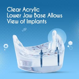iDENTical Mandibular Overdenture Model with 2 Implants M6002 - 16