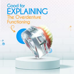 iDENTical Mandibular Overdenture Model with 2 Implants M6002 - 15