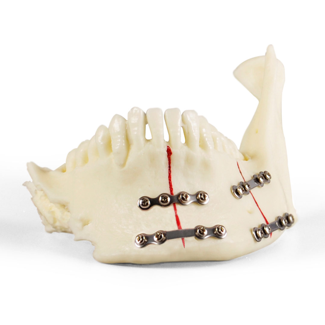 iDENTical Jaw with Titanium Plate Model M5001