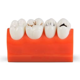 iDENTical Caries Model M4013 - 2