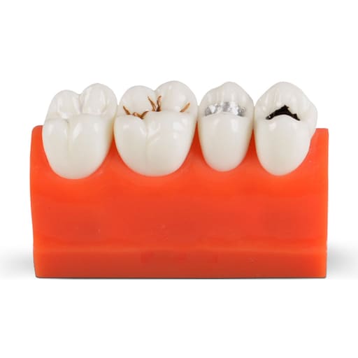 iDENTical Caries Model M4013