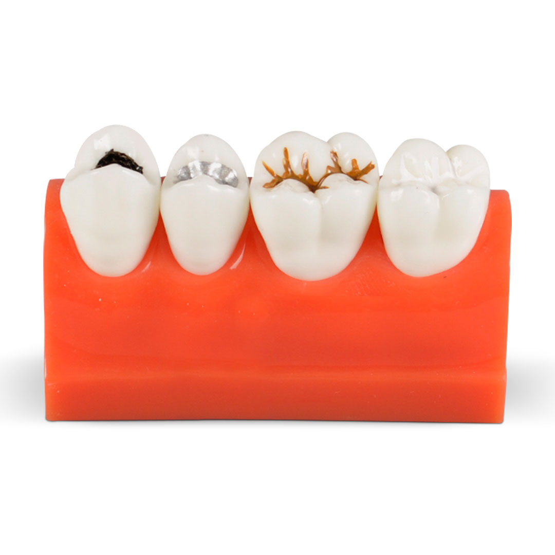 iDENTical Caries Model M4013