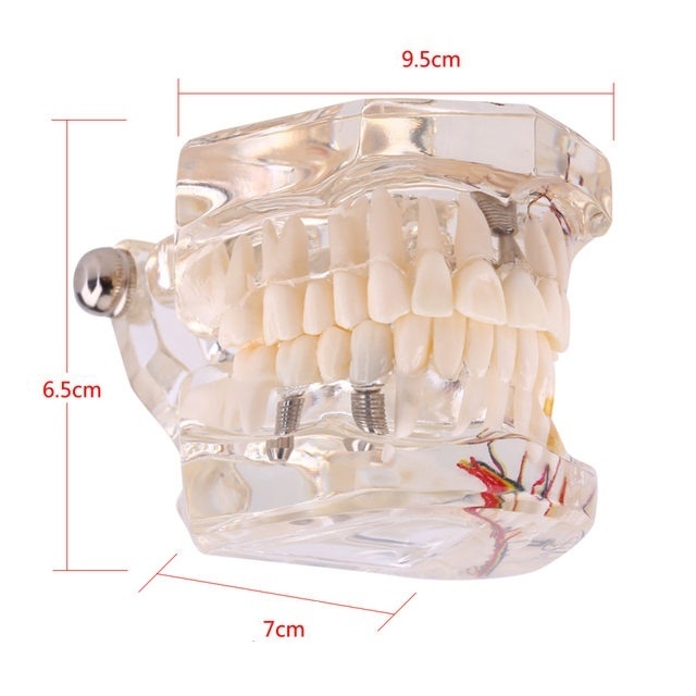iDENTical Patient Education Model (Caries,implant,Nerves) M2001-3