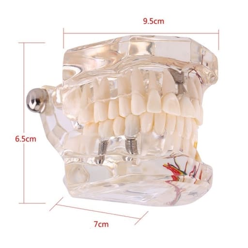 iDENTical Patient Education Model (Caries,implant,Nerves) M2001-3