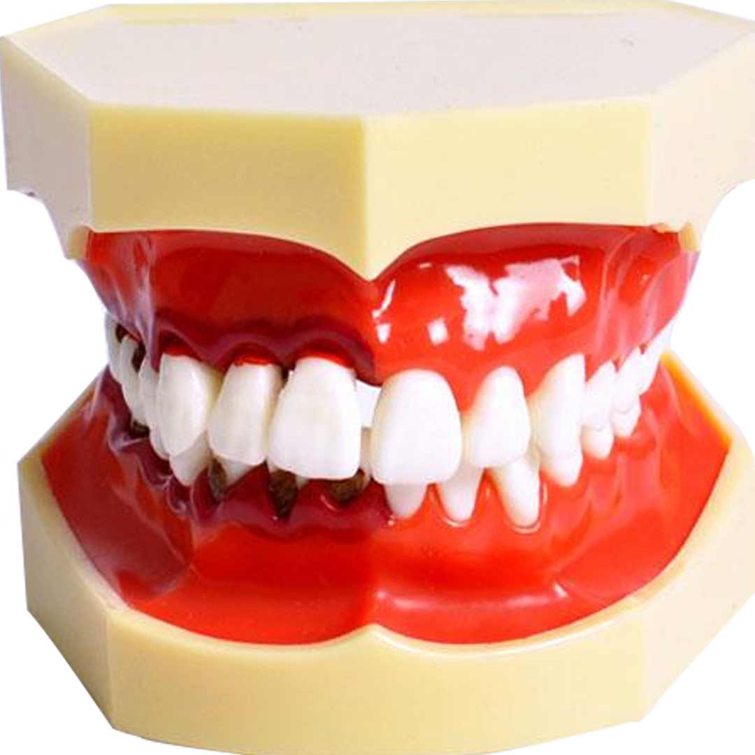 iDENTical Periodontal Disease Model M4025