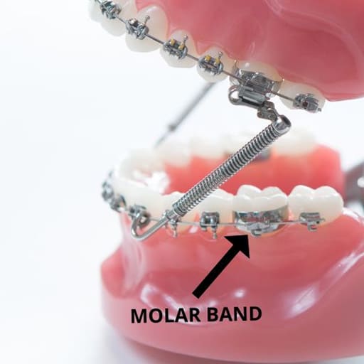 OSL 1st Molar Prewelded Molar Bands Roth 0.018 U3/L2 (Pack Of 4)