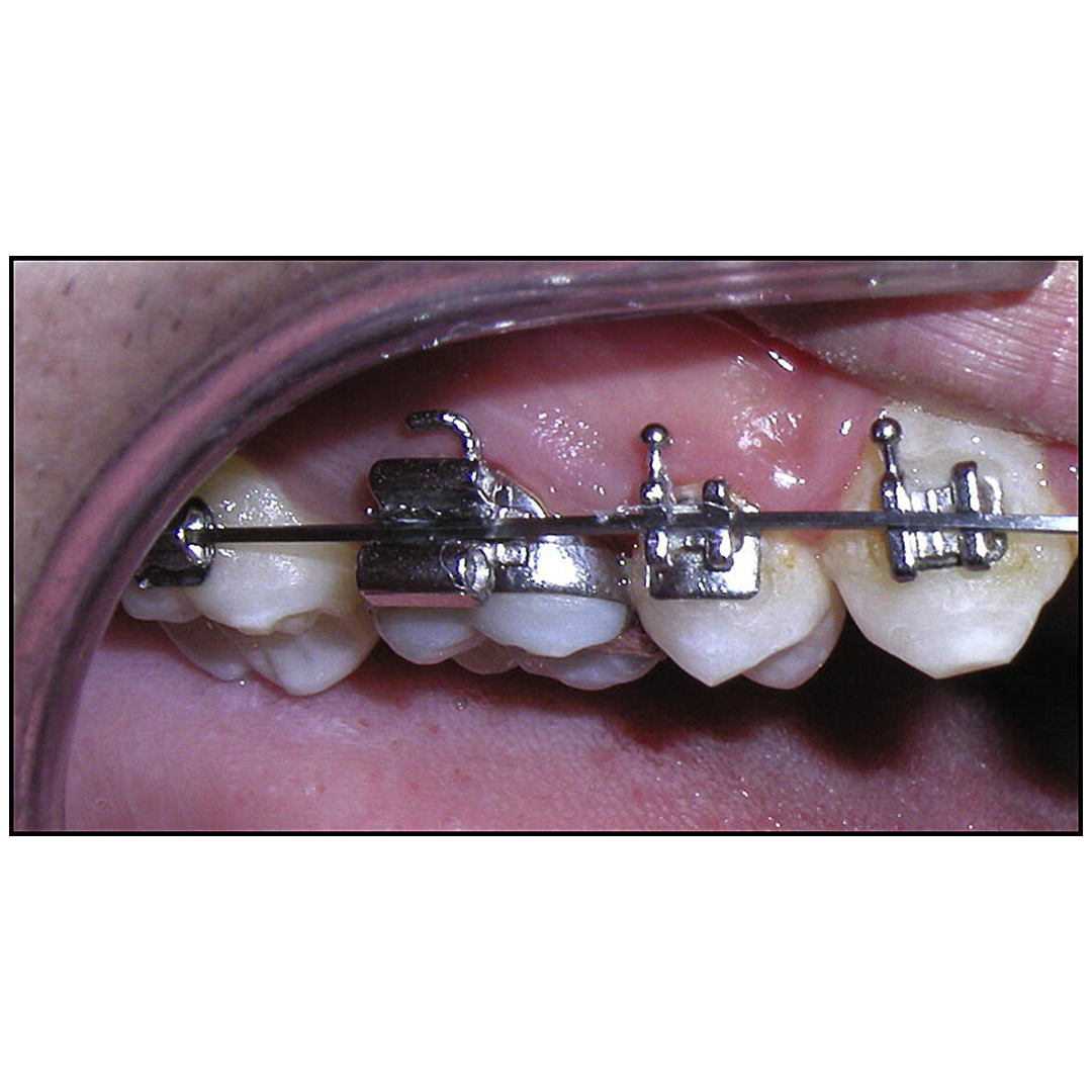 OSL 1st Molar Prewelded Molar Bands MBT 0.022 U3/L2 (Pack Of 4)