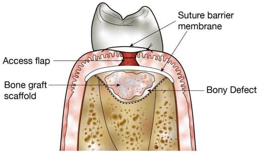 Advanced Biotech Osseograft DMBM Xenograft