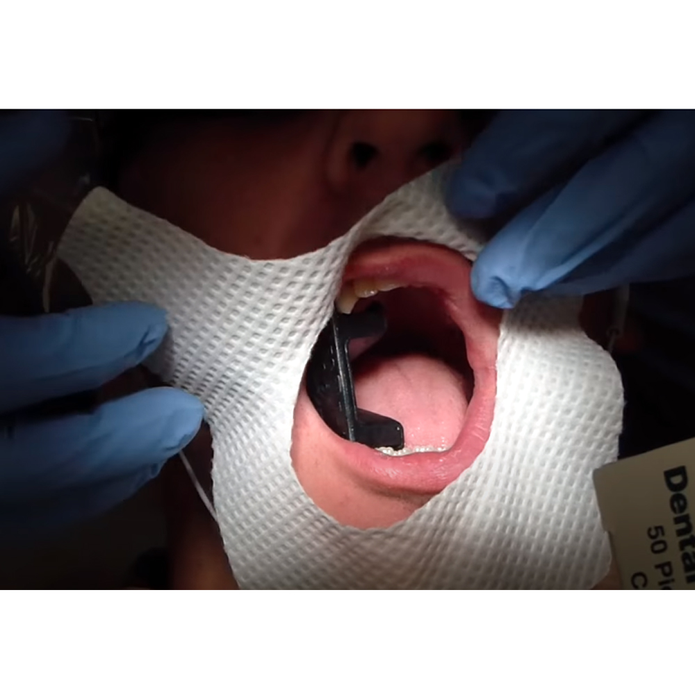 GDC Mouth Prop Set of 3 Pcs MP3