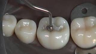 GI Dental Ball Burnisher