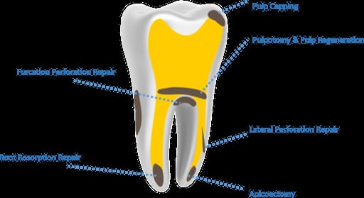 Kids-e-Dental E-MTA (Mineral Trioxide Aggregate)
