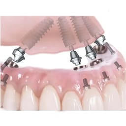 Xcem Conical Multi Angled Abutment - Hex - 2
