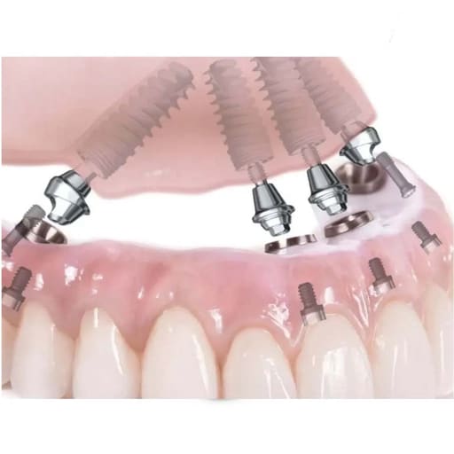 Xcem Conical Multi Angled Abutment - Hex