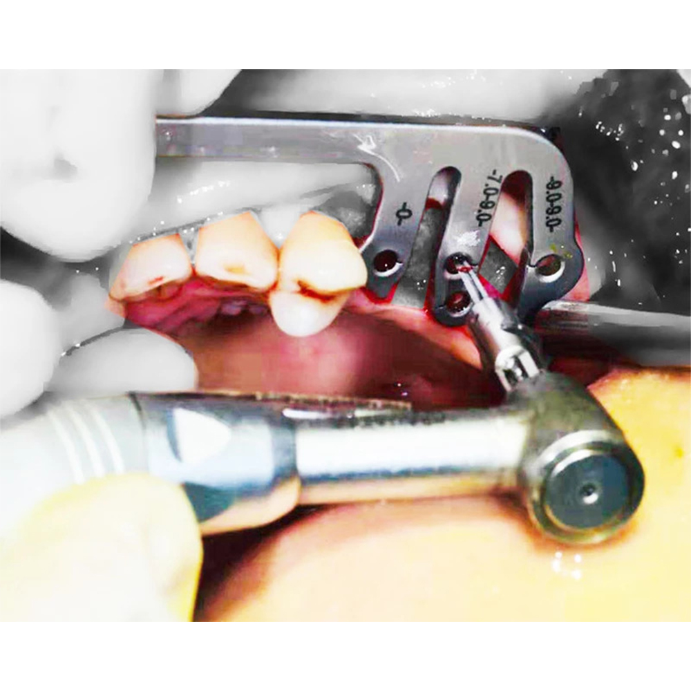 Julldent Multiple Implant Guide