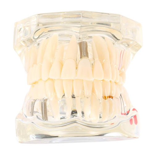 iDentical All In One Dental Implant Model - M2001 (White)