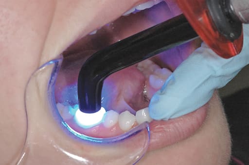 DentGist Light Cure Probe Type -1