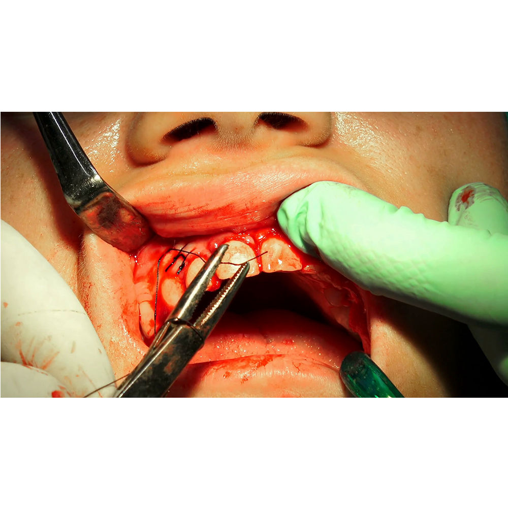 GDC Needle Holder Adson (Nha)