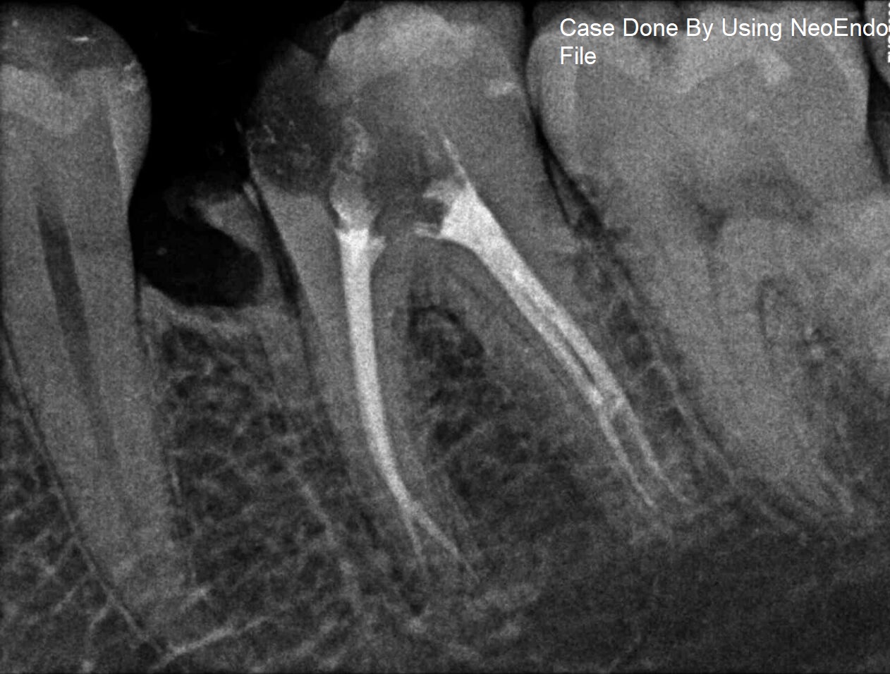 NeoEndo Flex Rotary Files 25mm