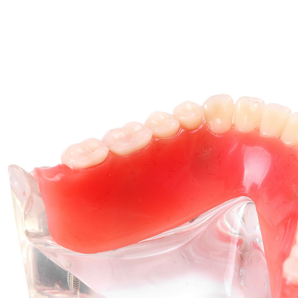 iDENTical Mandibular Overdenture Model with 4 Implants M6003