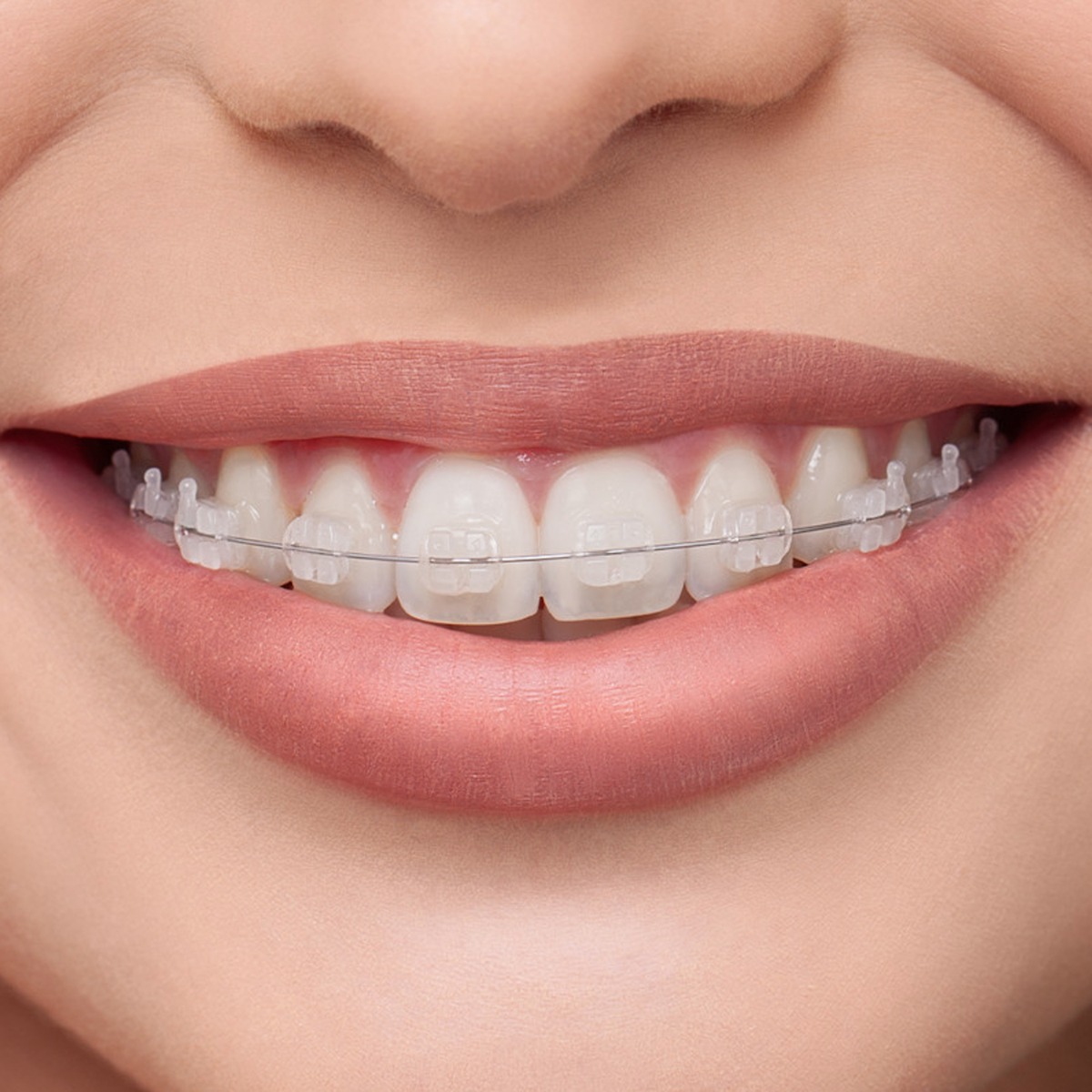 OrthoMetric Flexy NiTi Thermal 35ºC Archwires - Rectangular (10/Pk)