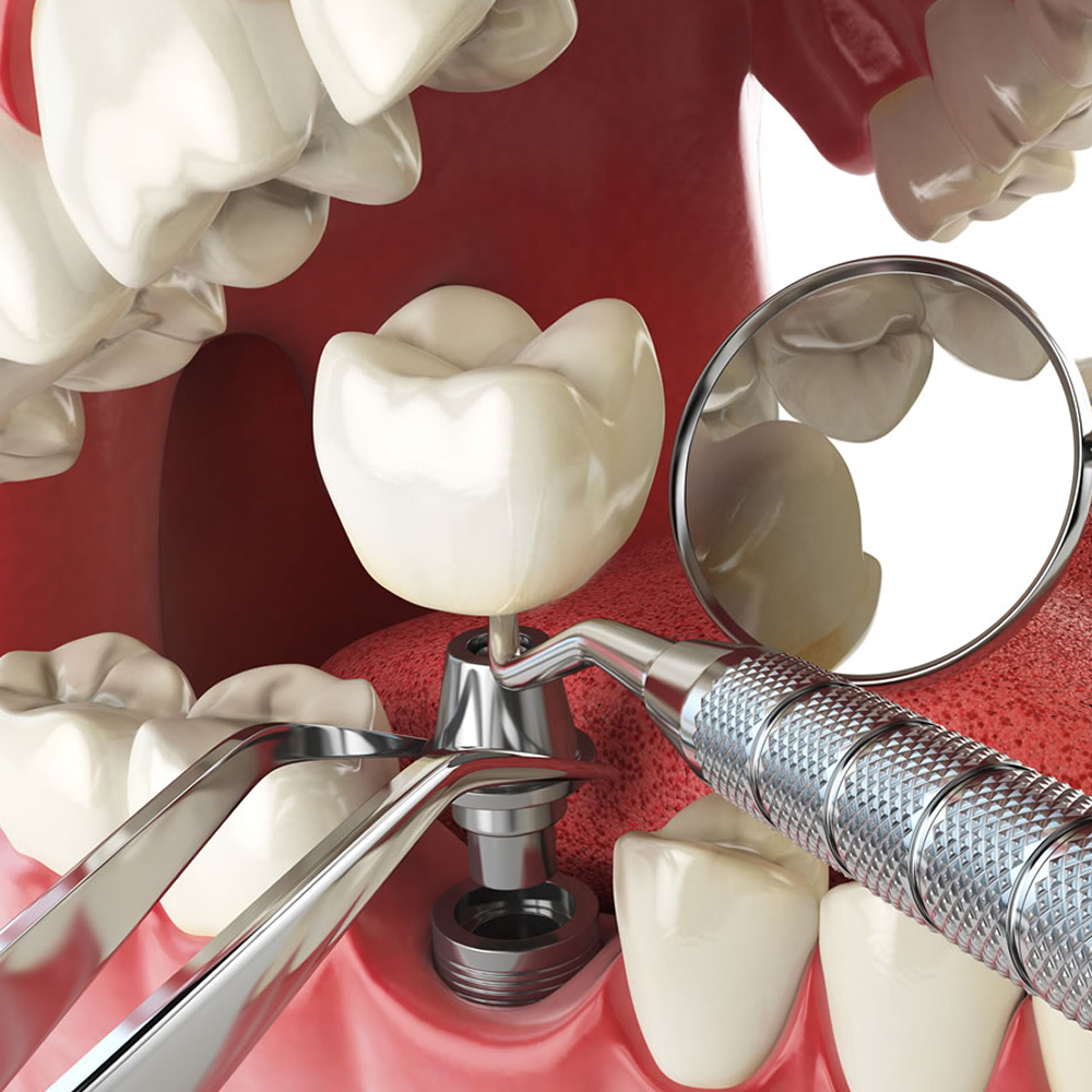 Nextin Straight Titanium Abutment No End Line - Hex 4.5mm x G/H 1mm x 10.4mm (P2810)