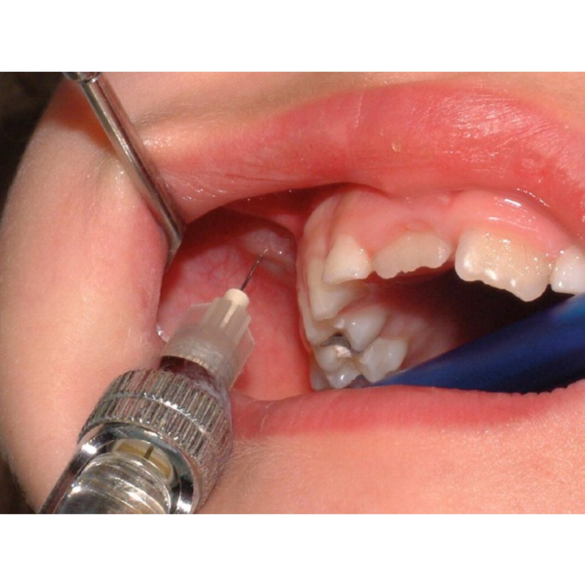 Oracraft Dental Syringe Non Aspirating