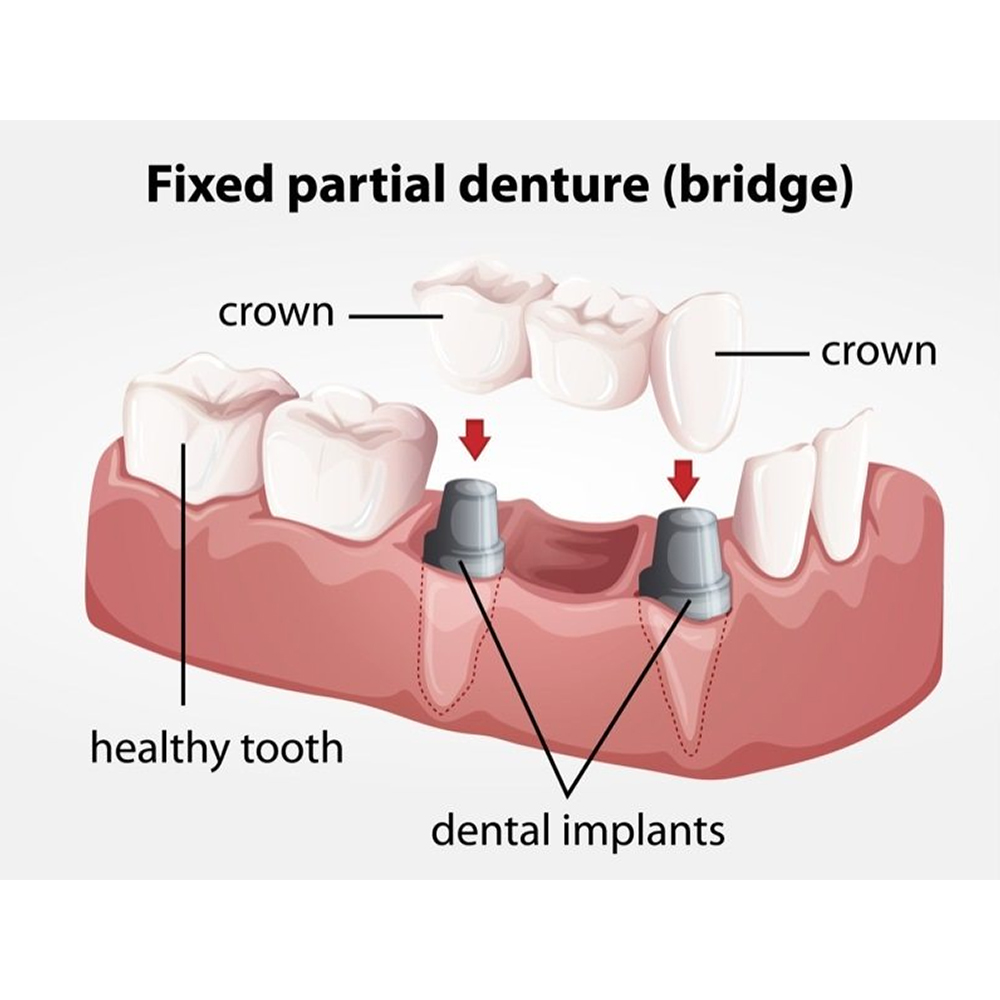 Xcem Dental Implant Transfer Abutment 5.5mm - Non Hex