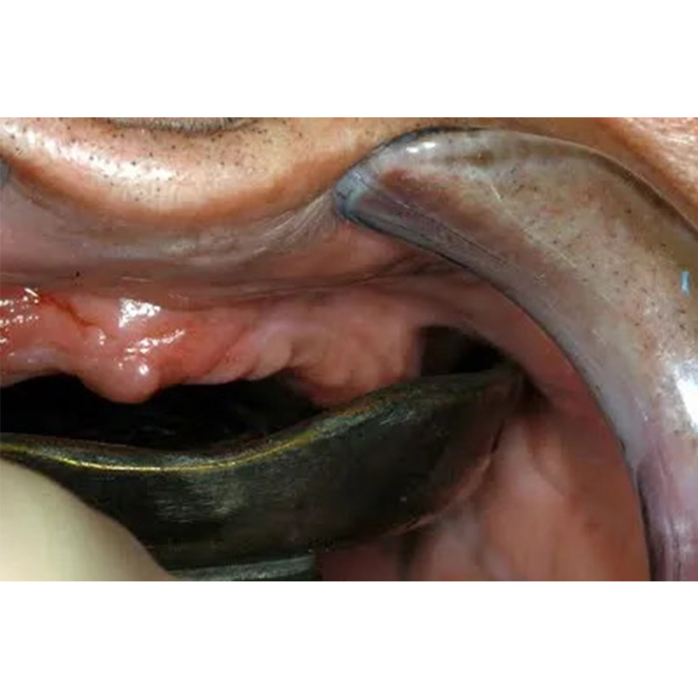 Gdc Impression Trays Edentulous Non-Perforated