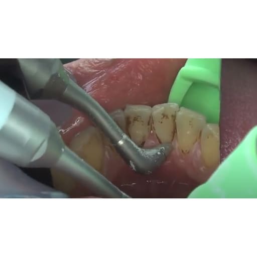 NSK Prophy-Mate Neo Dental Air Polisher PMNG-PTL-P (Y135029)