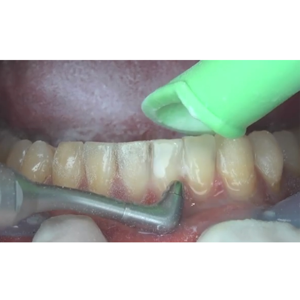 NSK Prophy-Mate Neo Dental Air Polisher PMNG-PTL-P (Y135029)