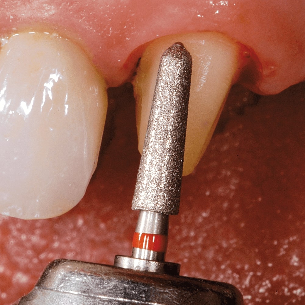 Frank Dental Straight Ogival FG Diamond Burs SO-Series (Fine)