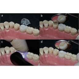 HN Dental Occlu Stamp - 6