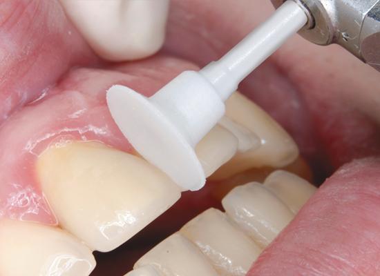 Shofu Onegloss Set Ca