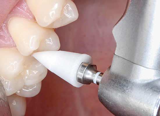 Shofu Onegloss Set Ca