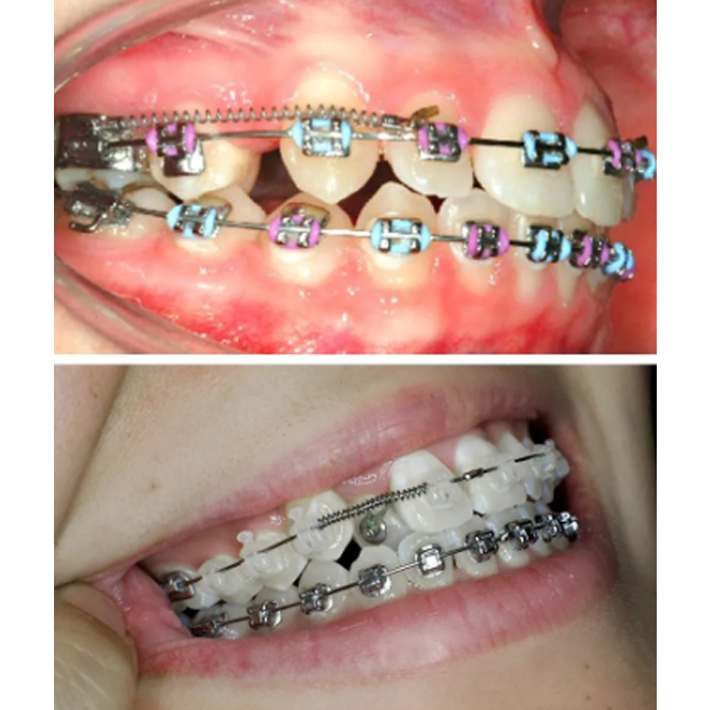 Koden NiTi Open Coil Spring 180mm (Pack of 2)