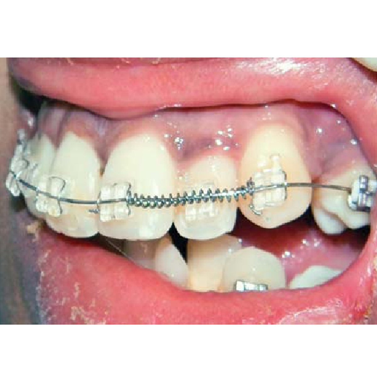 JJ Ortho NiTi Open Coil Spring 180mm (60.01.17)